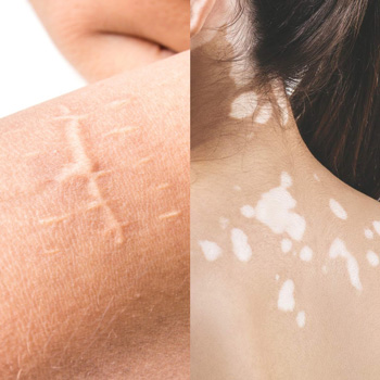 Cicatrices, vitiligo et autres problématiques