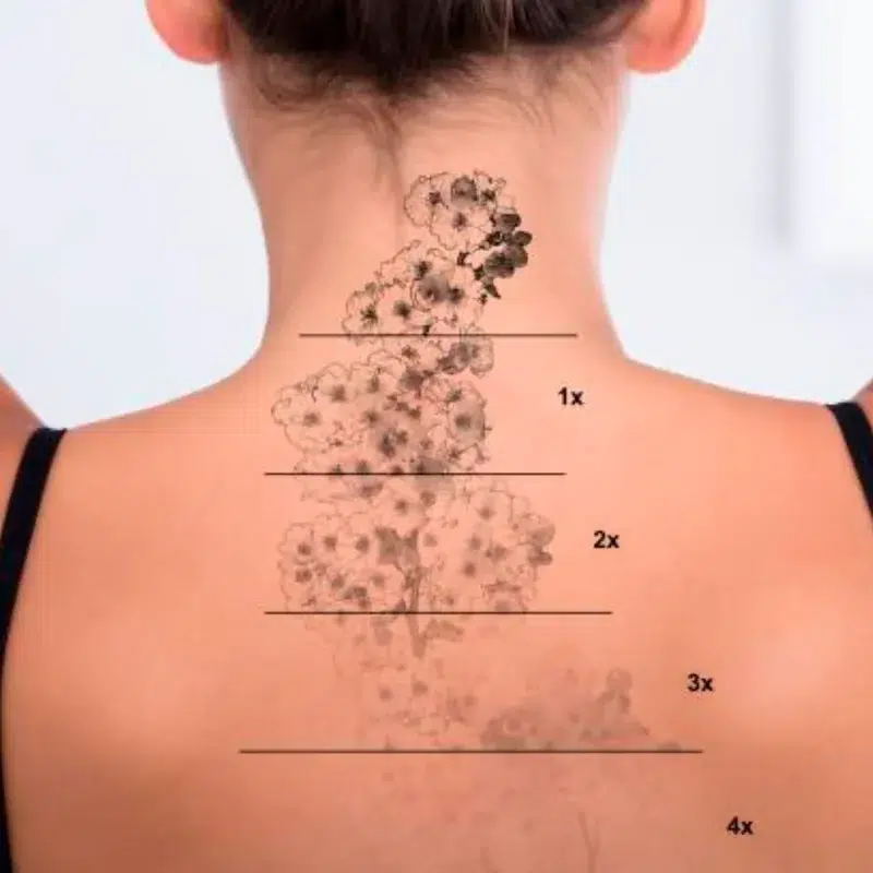 Maquillage permanent depigmentation