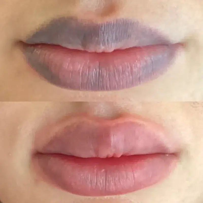 Maquillage permanent depigmentation